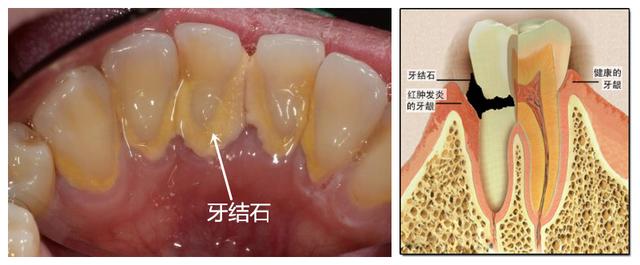 用手抠过牙结石吗?附抠牙教程