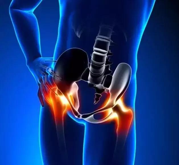 股骨头坏死早期症状