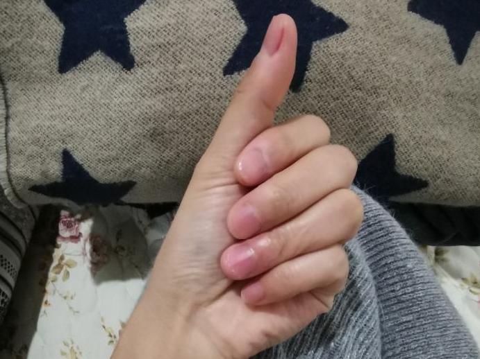 这算病吗?从小喜欢咬手指头,现在手指长得像芋艿。